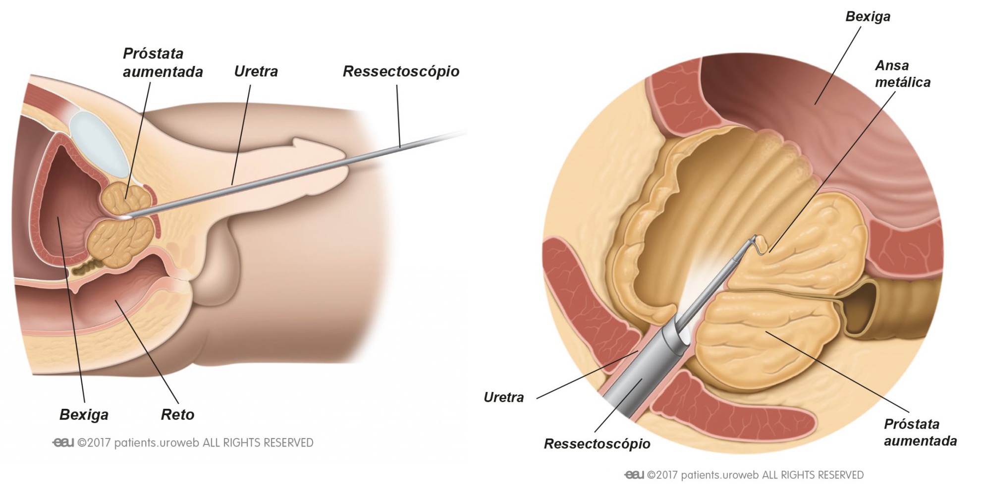 resseccao-prostata.jpeg