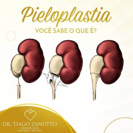 Pieloplastia