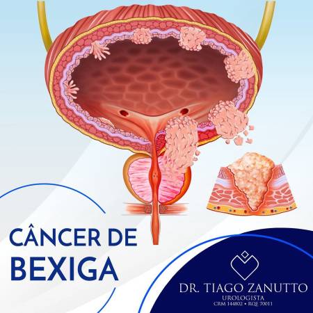 Câncer de bexiga