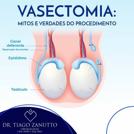 Vasectomia