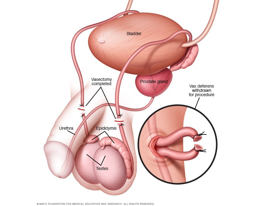 vasectomia-1.jpg